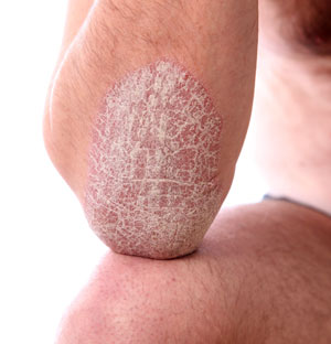 Poruchy rohovění kůže