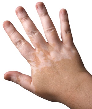 Vitiligo – primární depigmentace